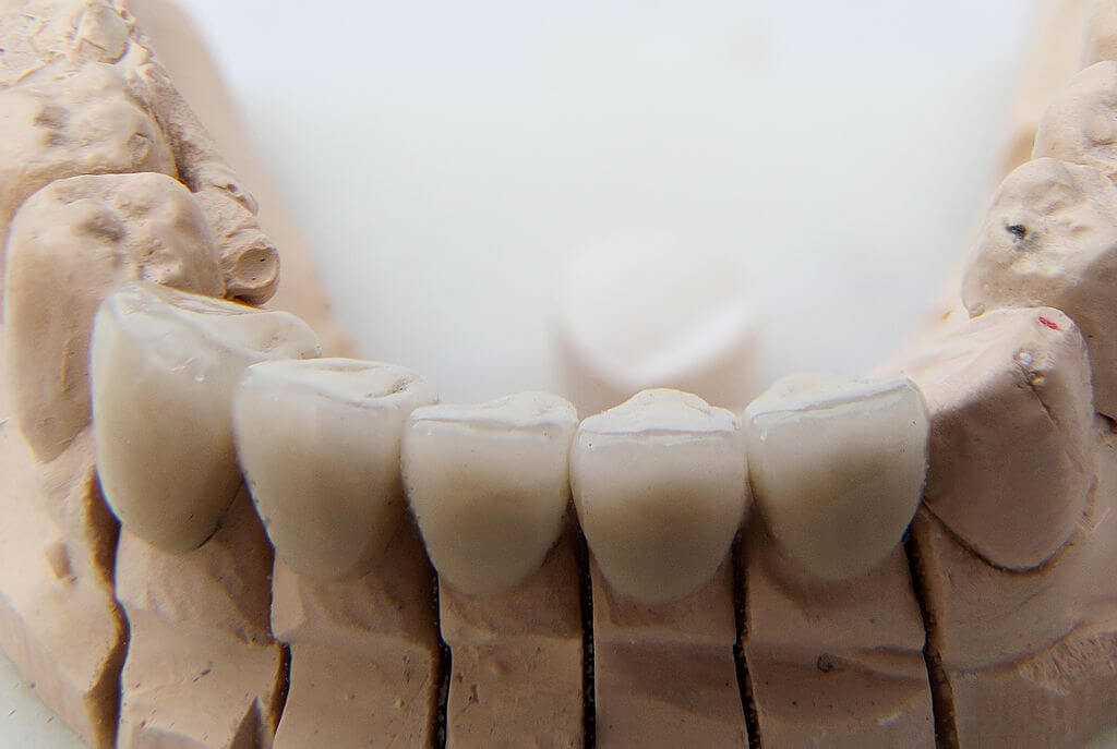 Dental crowns are made from a variety of materials, and are fitted using forms based on the client's teeth.