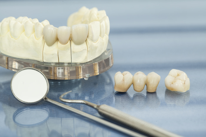 What Does Full Mouth Restoration Include