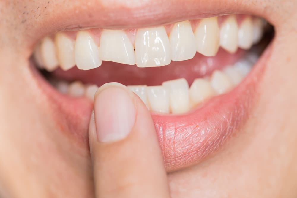 What Should You Do When You Chip a Tooth?