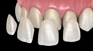 matching porcelain veneers to teeth