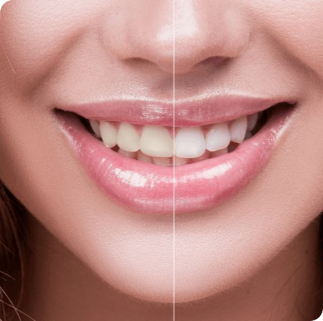 Before and After of a woman's smile getting teeth whitening.