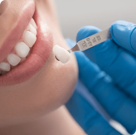 Close up of a dentist checking teeth for a porcelain inlay.