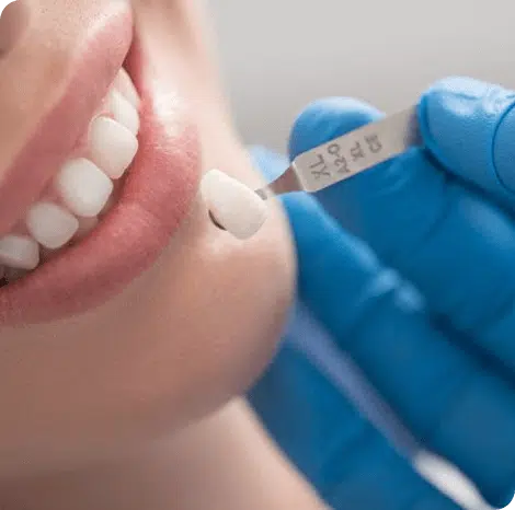 Close up of a dentist checking teeth for a porcelain inlay.