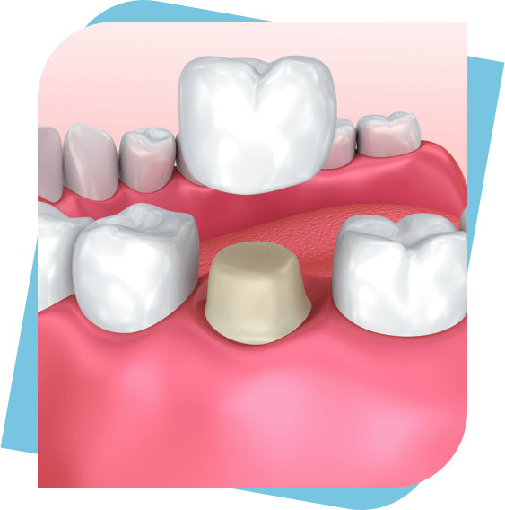 3D diagram of a dental crown.