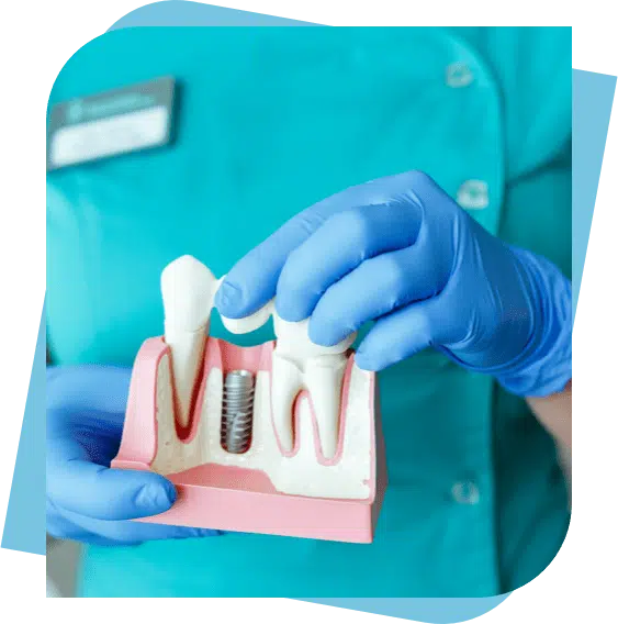 Dentist showing a model of a dental implant.