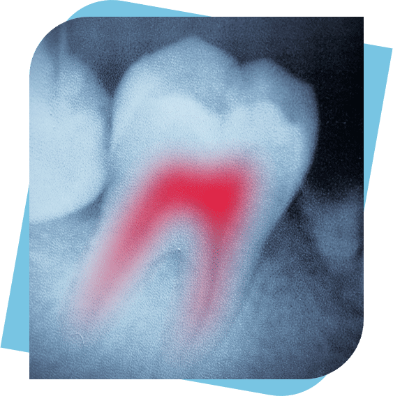 X-Ray of a tooth with a red highlighted root.