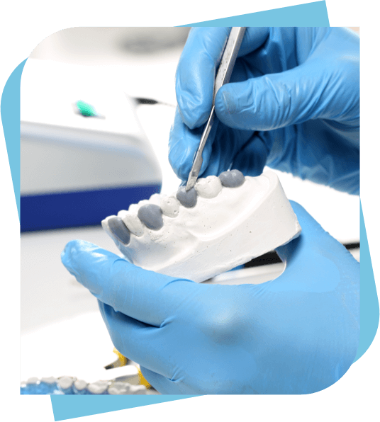 Dentist creating a mould for a dental bridge.