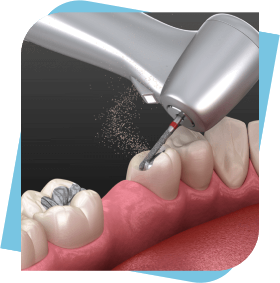 3D Diagram of a dental drill treating a cavity