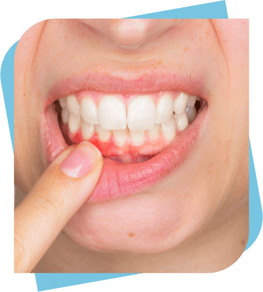 Closeup of a man with gum disease.