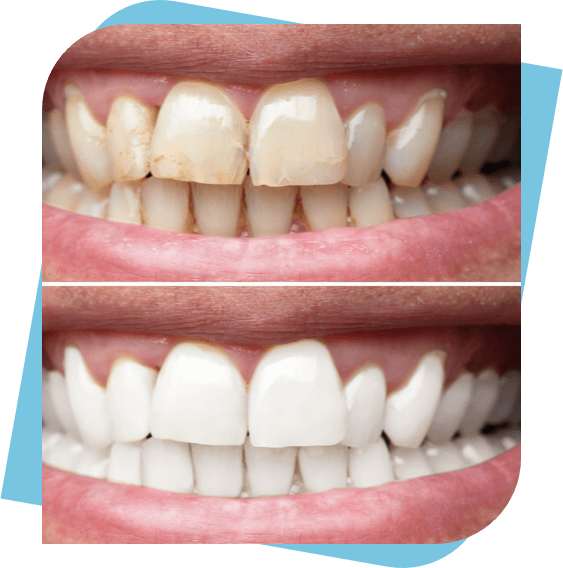 Before and After photo of man's cleaned and whitened teeth.