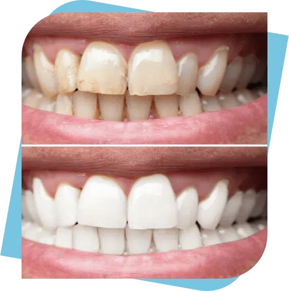 Before and After photo of man's cleaned and whitened teeth.