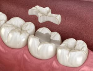 dental onlay placed on teeth