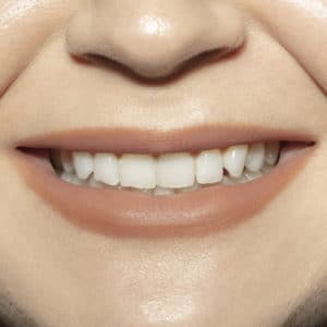 woman smiling teeth whitening