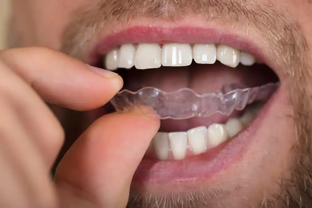 dental patient custom mouth guard