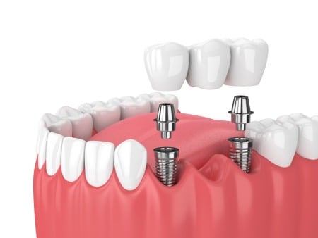 dental bridge attaching to the dental implant and post