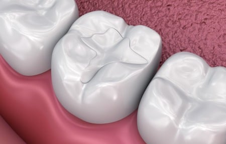 render of dental fillings in the cavity of a tooth