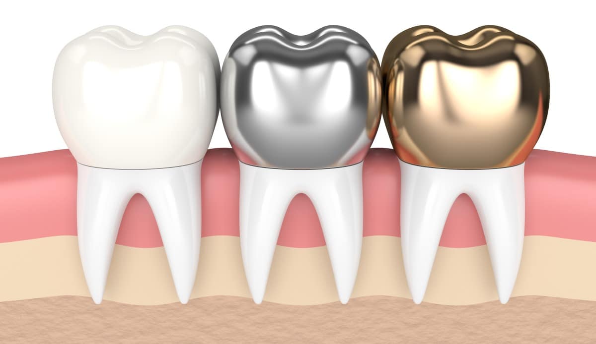 porcelain fused, metal and gold dental crown