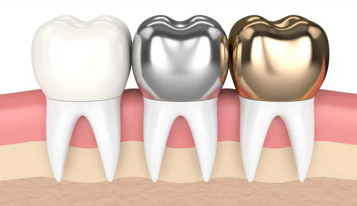 porcelain fused, metal and gold dental crown