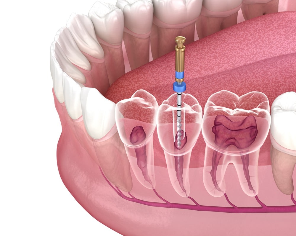 How to Avoid a Root Canal Procedure