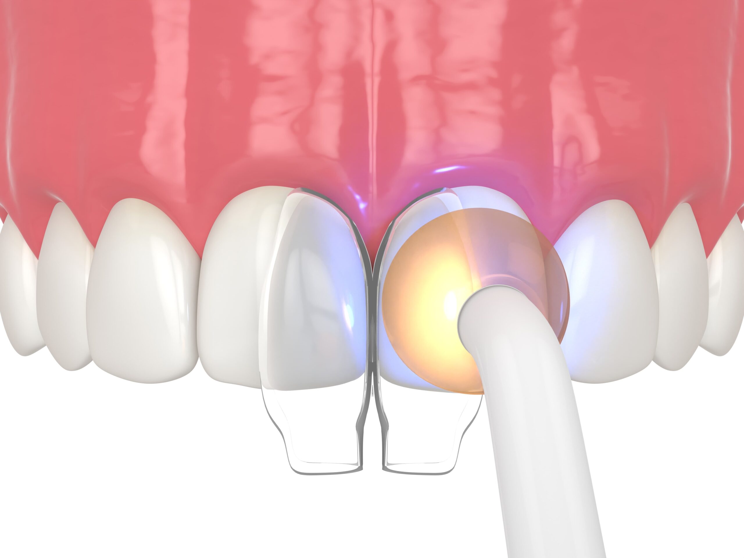 A graphic showing the dental bonding process.