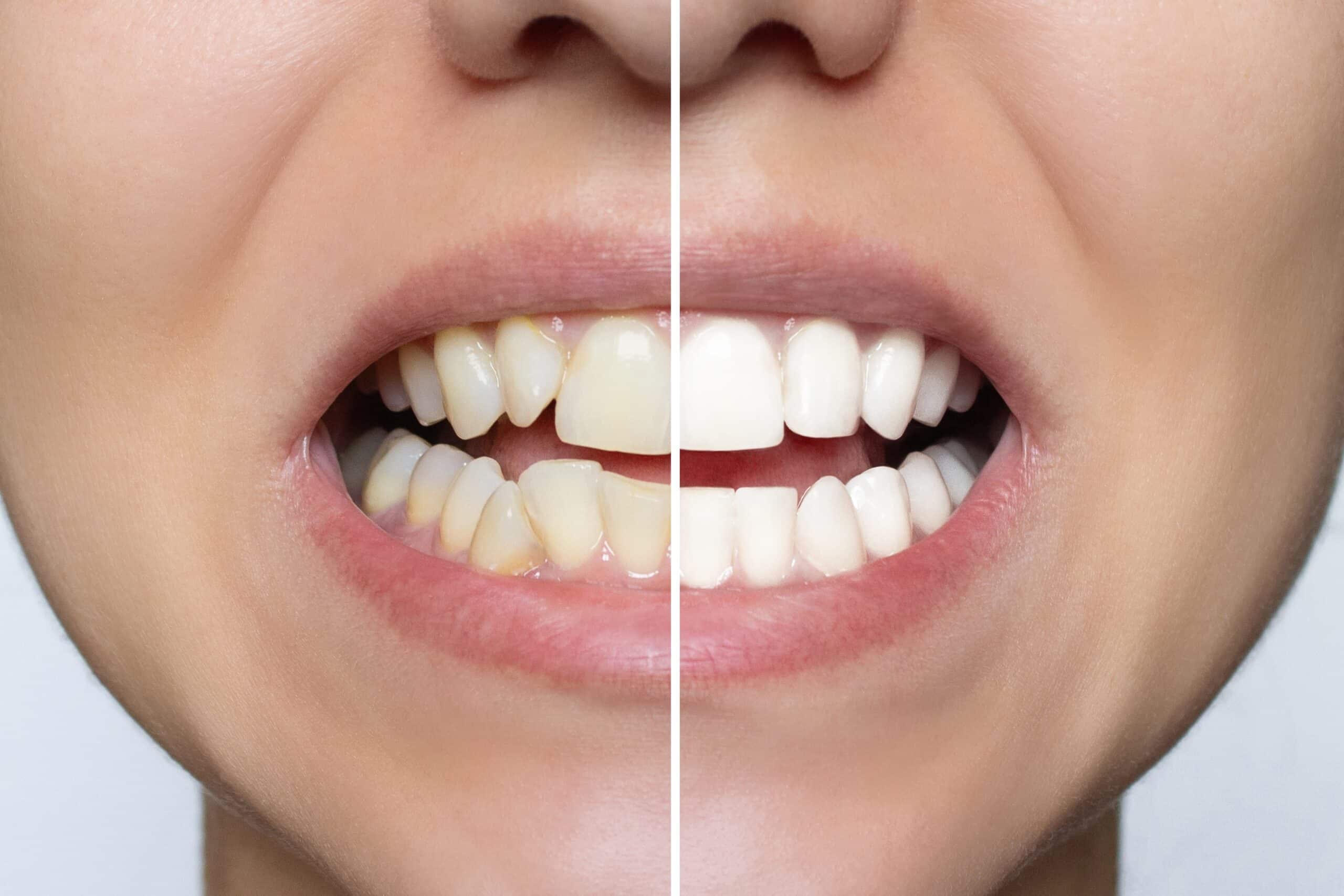 A photo showing the before and after dental vaneer installation.