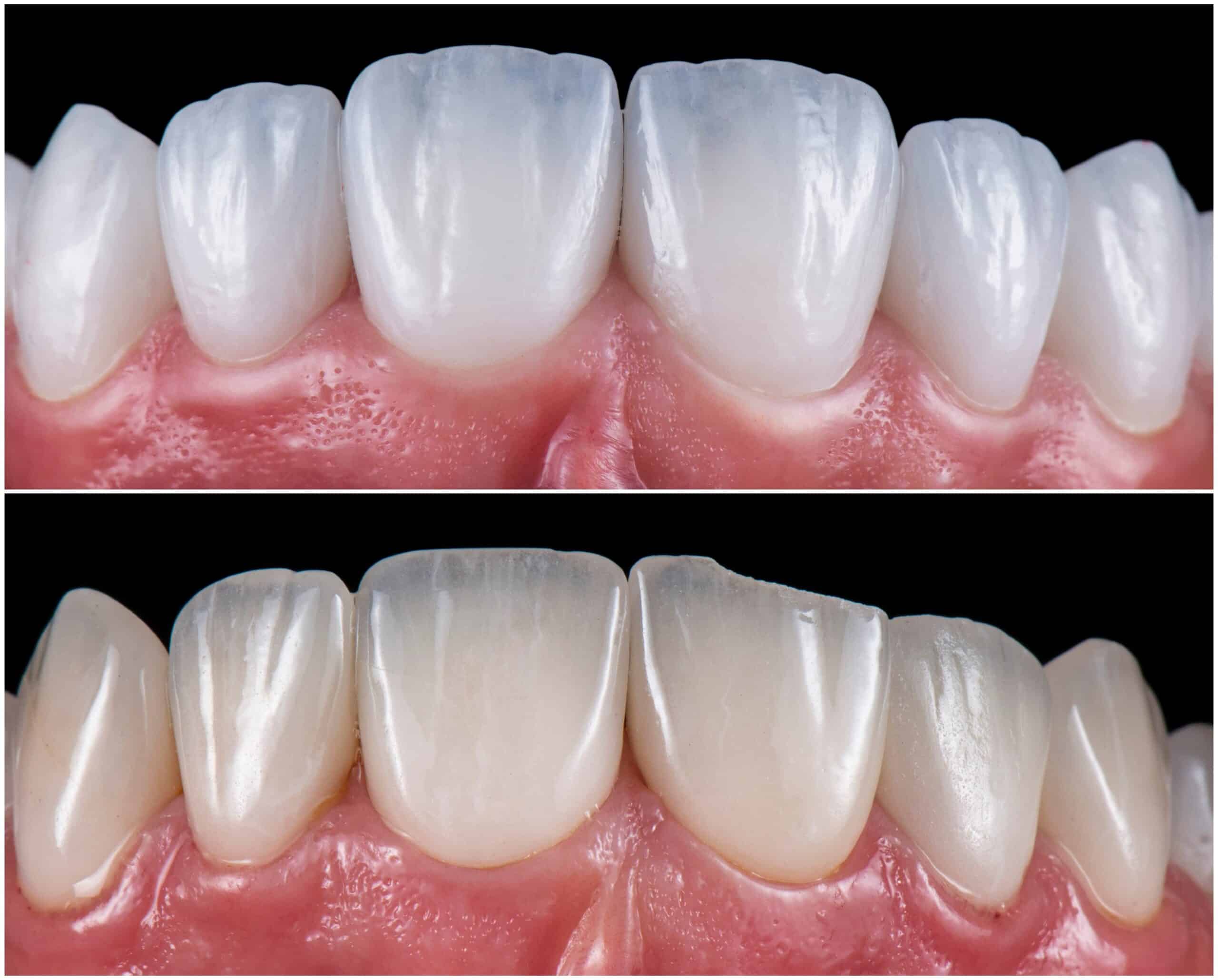 A photo showing the before and after of installing dental crowns.