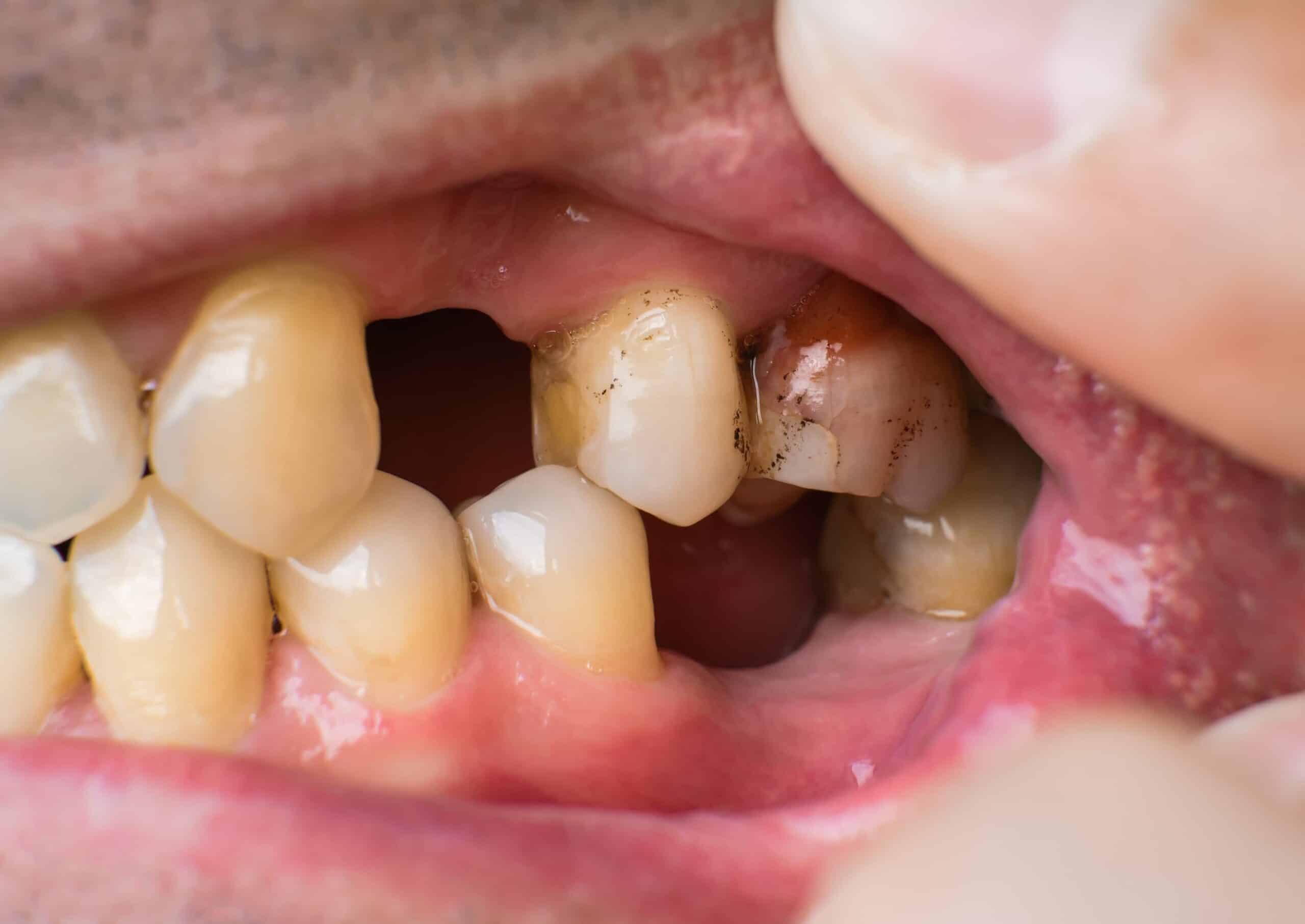 A photo of a man missing teeth.